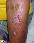 factitial dermatitis