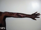 factitial dermatitis