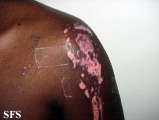 factitial dermatitis
