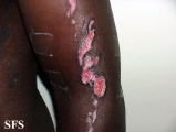 factitial dermatitis