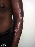 factitial dermatitis