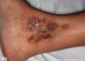 livedoid vasculopathy