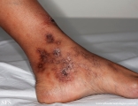 livedoid vasculopathy