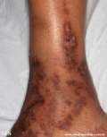 livedoid vasculopathy