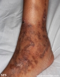 livedoid vasculopathy