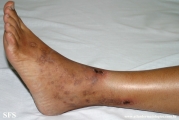 livedoid vasculopathy