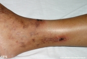 livedoid vasculopathy