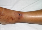 livedoid vasculopathy