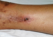 livedoid vasculopathy