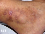 livedoid vasculopathy