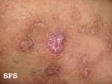 livedoid vasculopathy