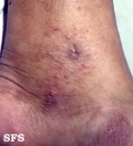 livedoid vasculopathy