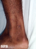 livedoid vasculopathy