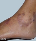 livedoid vasculopathy