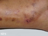 livedoid vasculopathy