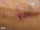 livedoid vasculopathy
