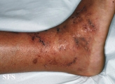livedoid vasculopathy