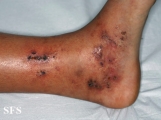 livedoid vasculopathy