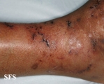 livedoid vasculopathy