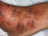 livedoid vasculopathy