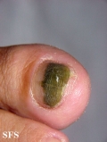 green nails-pseudomonas aeruginosa