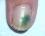 green nails-pseudomonas aeruginosa