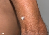 keratoacanthoma