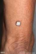 keratoacanthoma