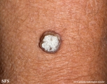 keratoacanthoma