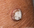 keratoacanthoma
