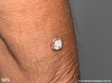 keratoacanthoma