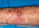 keratoacanthoma