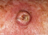 keratoacanthoma