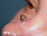 keratoacanthoma