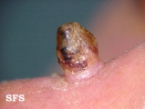 keratoacanthoma