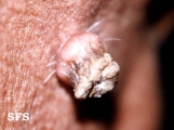 keratoacanthoma
