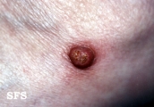 keratoacanthoma