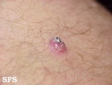 keratoacanthoma