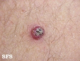keratoacanthoma