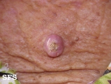 keratoacanthoma