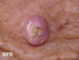 keratoacanthoma