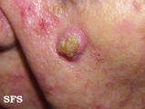 keratoacanthoma