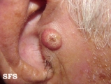 keratoacanthoma