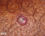 keratoacanthoma