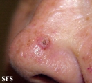 keratoacanthoma