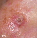 keratoacanthoma