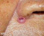 keratoacanthoma