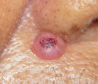 keratoacanthoma