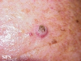 keratoacanthoma