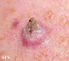 keratoacanthoma